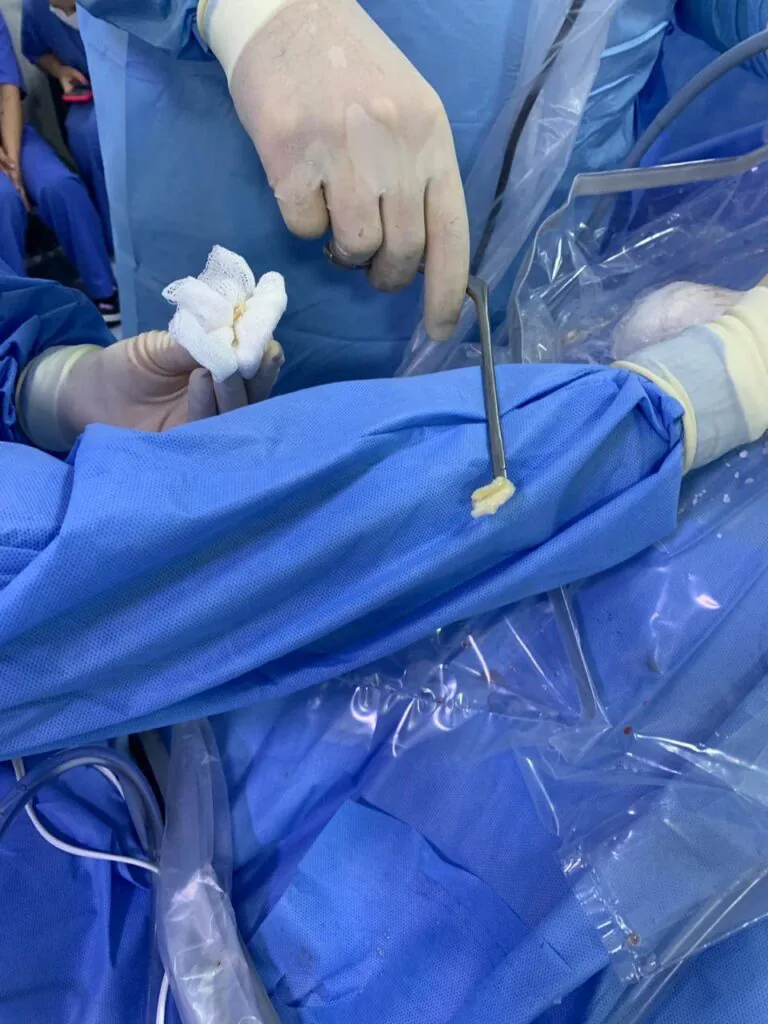 Comparação entre técnicas uniportal e biportal