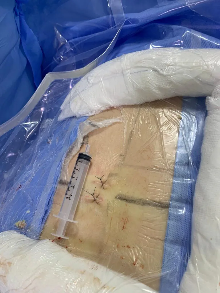 Técnica biportal — cirurgia endoscópica da coluna lombar