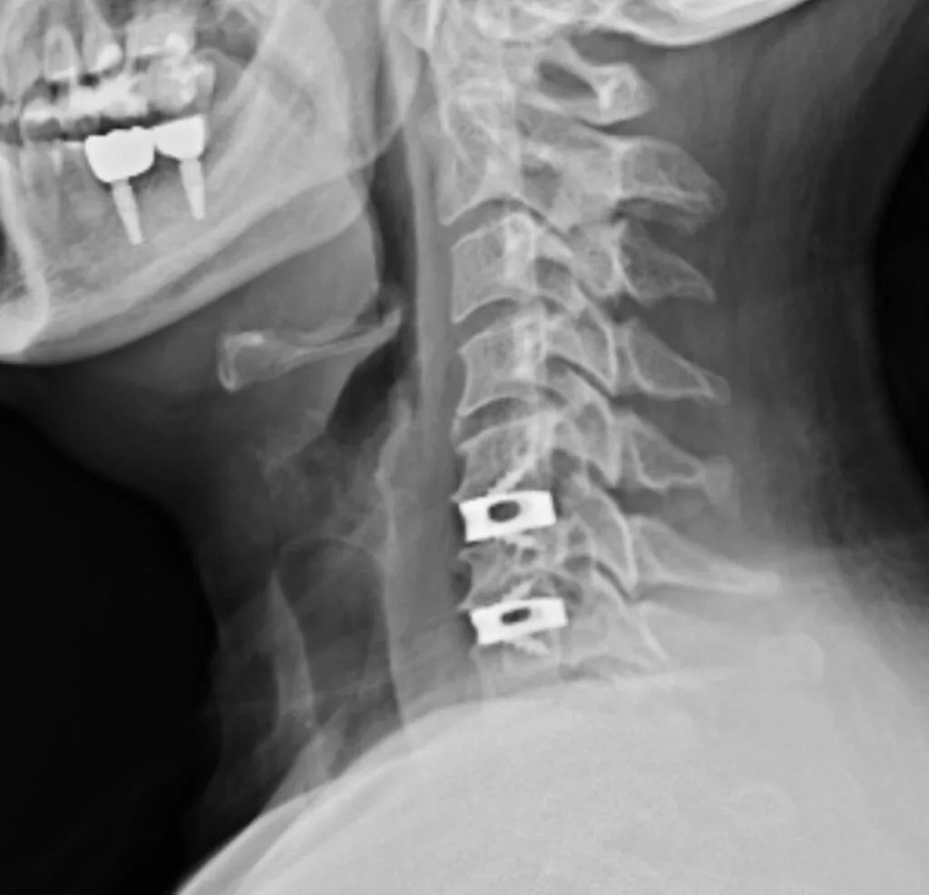 Centro cirúrgico — cirurgia para hérnia de disco cervical