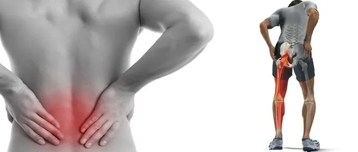 Ilustração do nervo ciático e área de irradiação da dor ciática