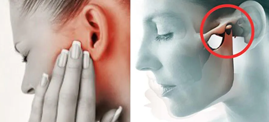 Mulher com dor facial e ilustração do nervo trigêmeo comprimido