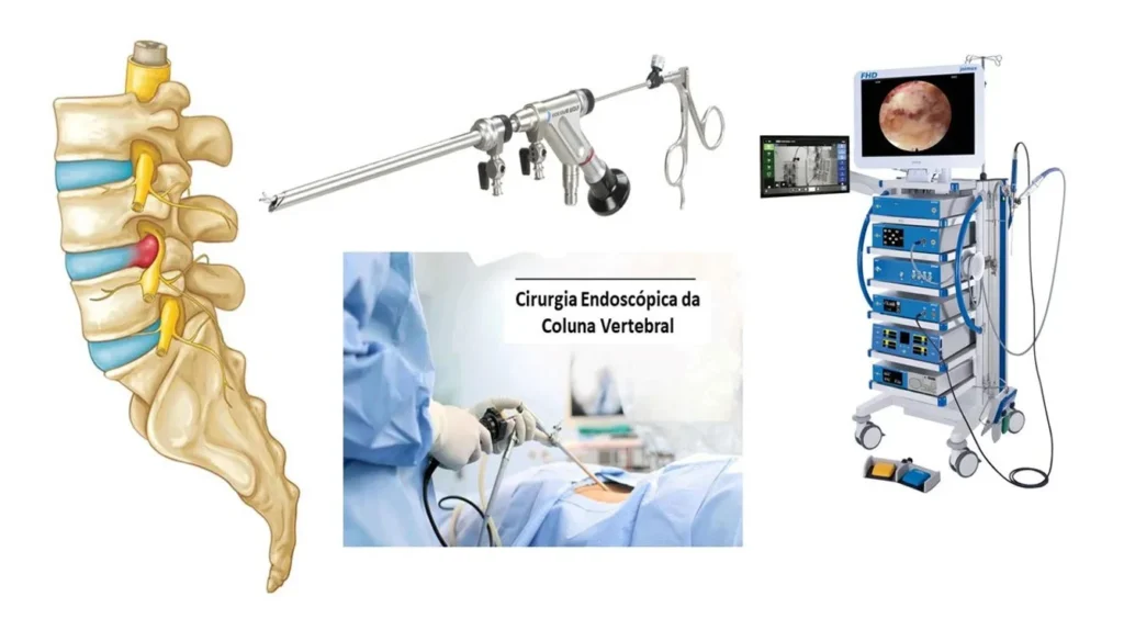 Cirurgia endoscópica da coluna lombar — visão do procedimento