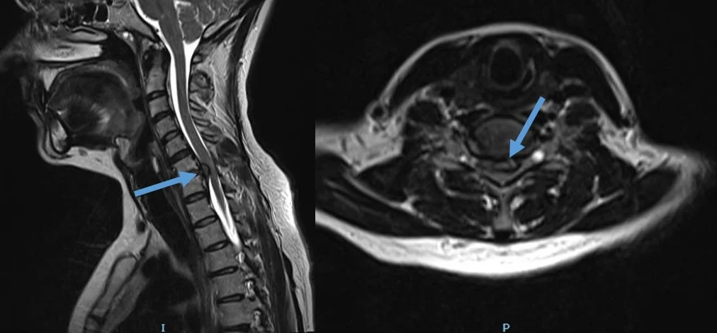 Médico analisando ressonância magnética de coluna cervical para indicação cirúrgica