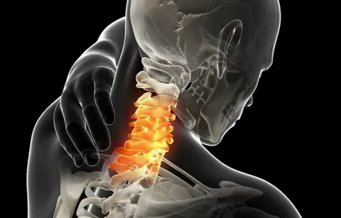 Hérnia de Disco Cervical