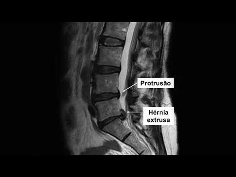 Médico analisando exame de ressonância magnética para diagnóstico de hérnia de disco