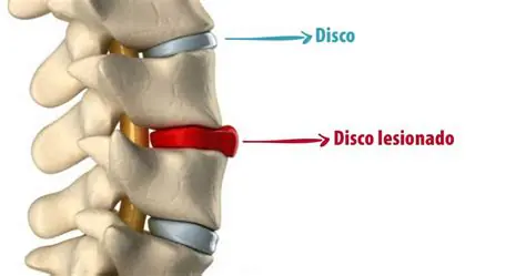 Hérnia de Disco