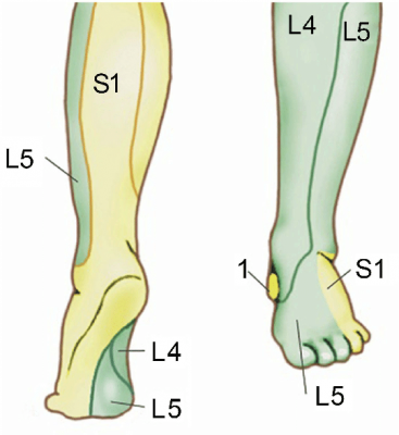 Síndrome da cauda equina por hérnia de disco lombar volumosa