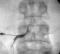 Imagem de infiltração foraminal L4 esquerda feita sob sedação
