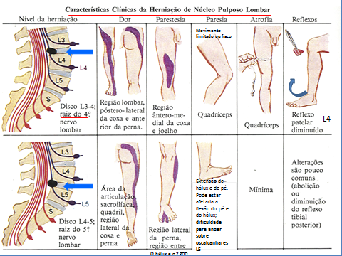 Diagrama de alterações ao exame físico neurológico em compressões de raízes lombares L4, L5 e S1