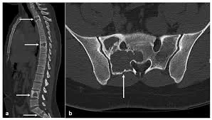 Tomografia de coluna lombar demonstrando lesão óssea associada
