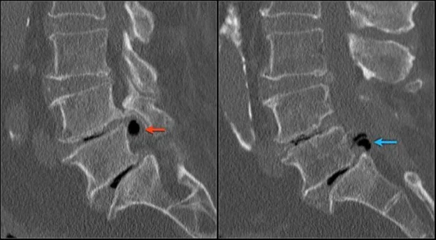 Tomografia de coluna lombar demonstrando áreas de degeneração discal e hérnias extrusas