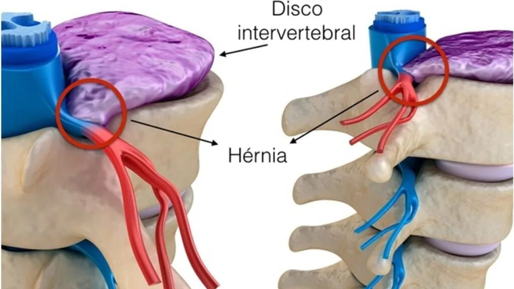 Ilustração de doenças da coluna vertebral tratadas pelo neurocirurgião