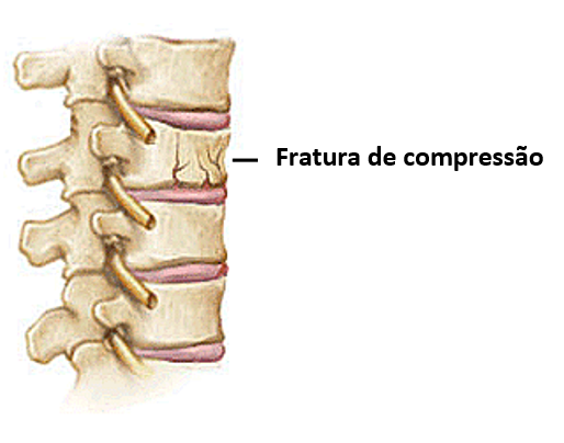 Ilustração de fratura por compressão vertebral causada por osteoporose