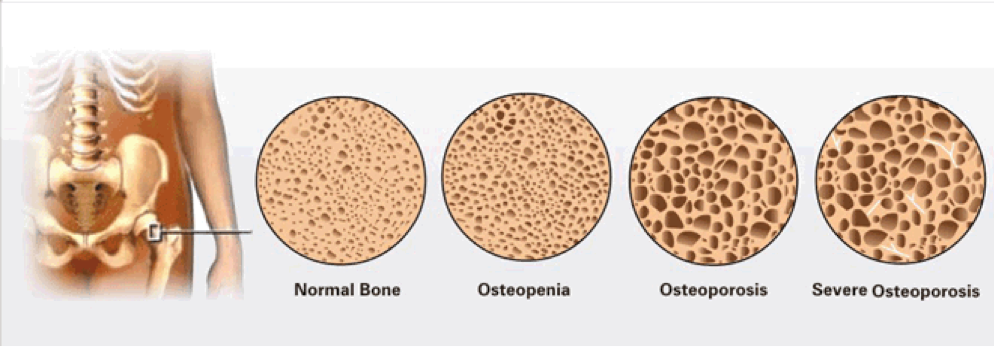 Comparação entre osteopenia e osteoporose no gráfico de T-score