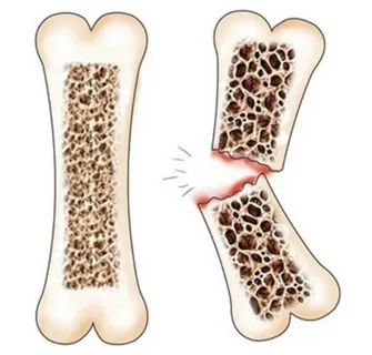 Mulher idosa — grupos de risco da osteoporose