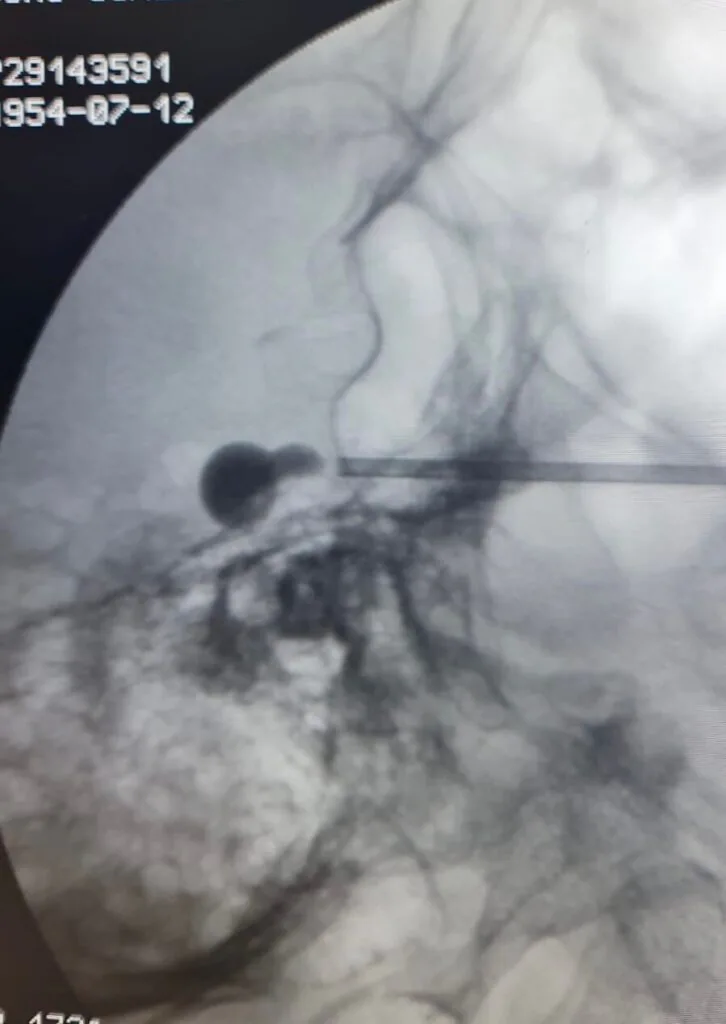 Procedimento minimamente invasivo para tratamento da nevralgia do trigêmeo