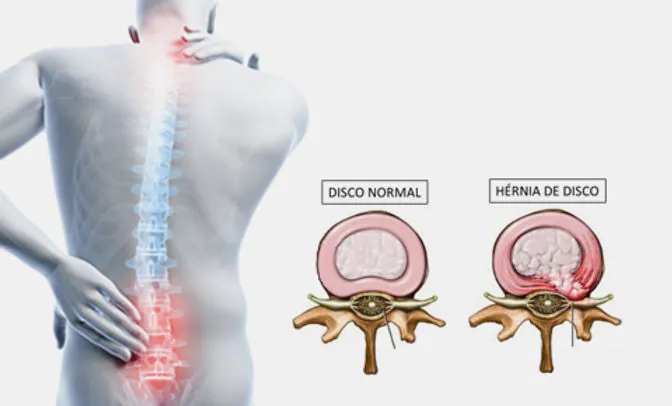 Cirurgia endoscópica versus cirurgia tradicional da coluna